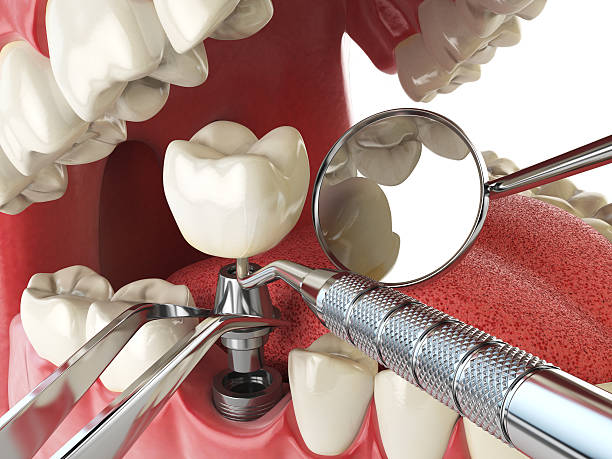 Best Broken or Chipped Tooth Repair in Val Verde Park, TX